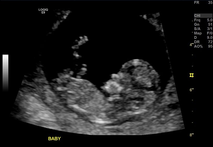 5 Tips to Survive the First Trimester Ultrasound Picture